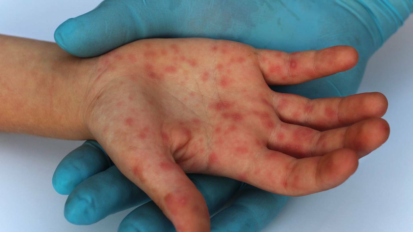 Vigilancia ha permitido identificar nuevos casos de viruela de mono