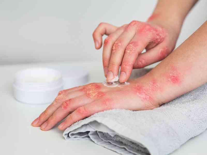 Viruela de mono detectada en saliva y semen