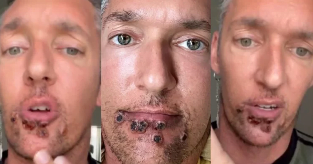 #VIRAL: Actor porno revela calvario tras contagio por Viruela Símica