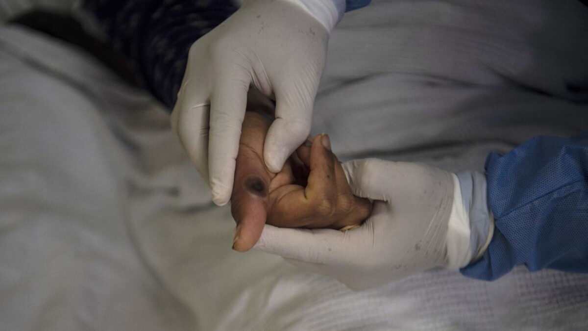 Jalisco notifica un nuevo caso de mpox en su territorio