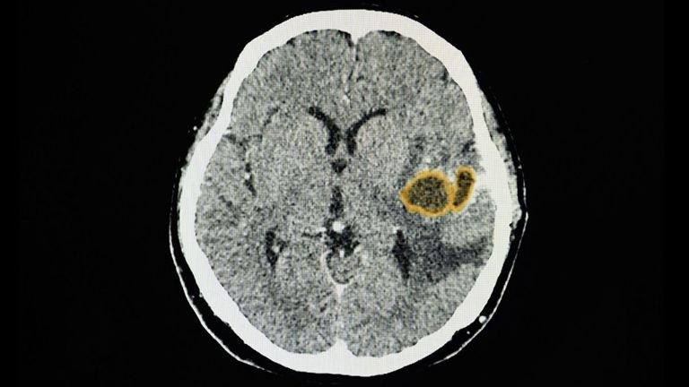 Médicos alertan por una fuerte infección cerebral en niños de EU