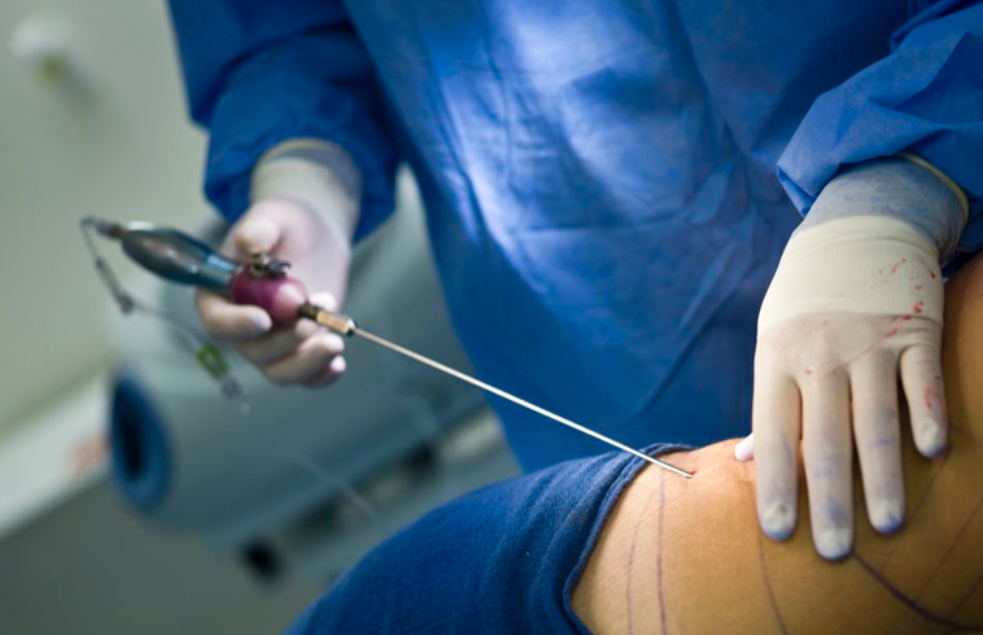 Joven muere tras realizarse una liposucción en Jalisco