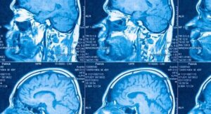 Científicos identifican dos subtipos biológicos del autismo