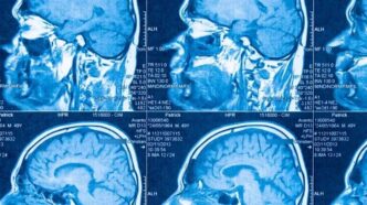 Científicos identifican dos subtipos biológicos del autismo